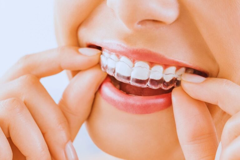 Corrección dental sin sacrificios, conoce las ventajas de la ortodoncia invisible